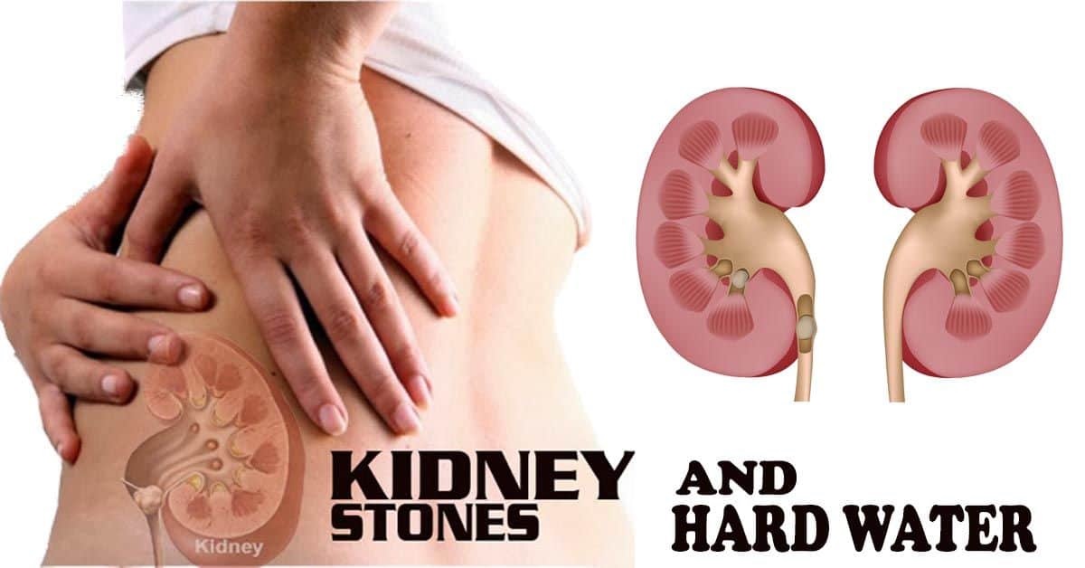The Link Between Dehydration and Kidney Stone Formation